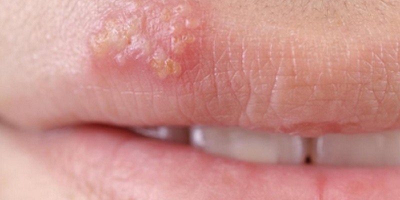 Nguyên nhân gây bệnh Herpes sinh học